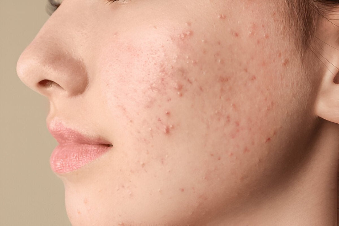 9 Tips to Get Rid of Acne Fast: Clear Skin Solutions - AU Beauty Bazaar