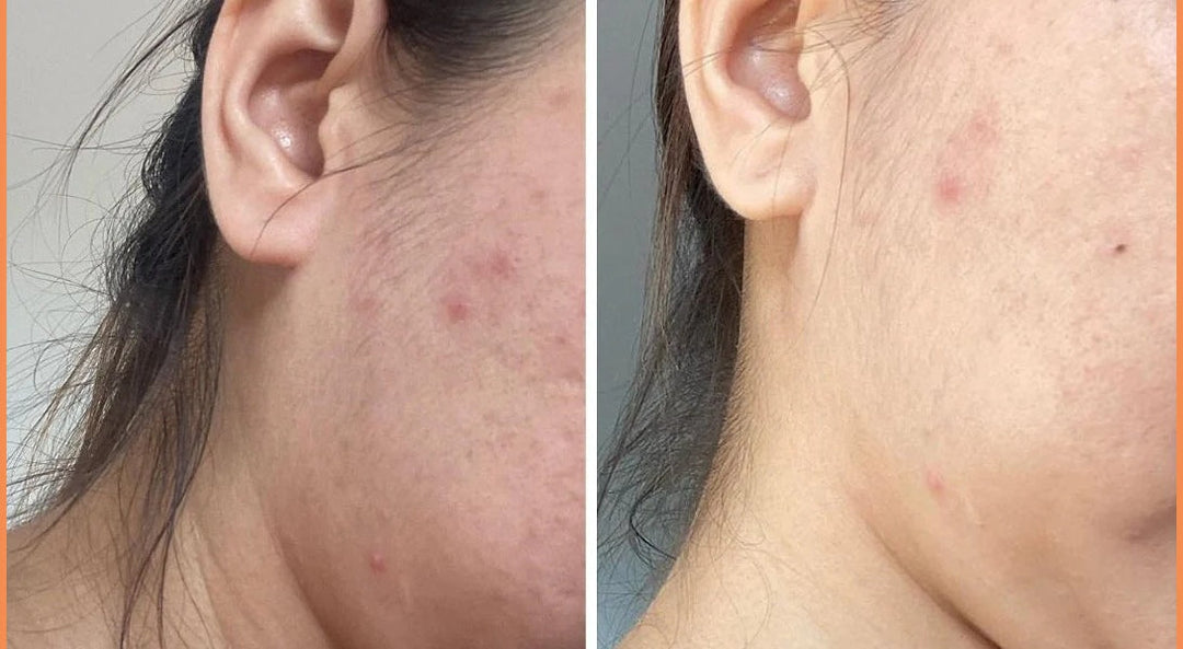 Top 5 Best Salicylic Acid Face Washes for Clear, Acne-Prone Skin AU BEAUTY BAZAAR