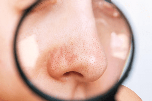 Banish Blackheads for Good: Proven Creams and Treatments That Work - AU Beauty Bazaar