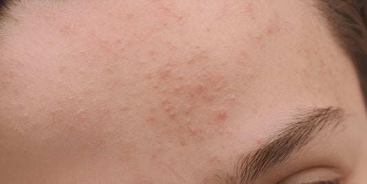 How to Get Rid of Stubborn Forehead Bumps: Tips & Tricks - AU Beauty Bazaar