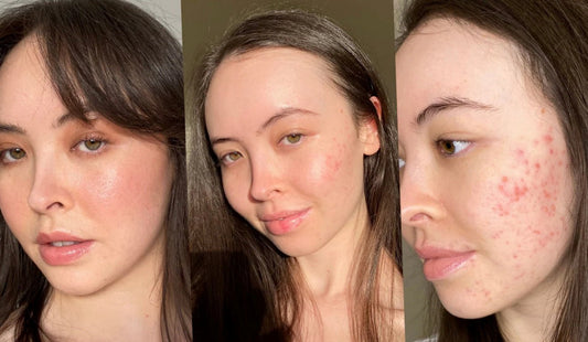 Korean Skincare for Acne-Prone Skin: Natural, Safe & Soothing Formulas - AU Beauty Bazaar