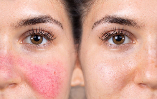 Rosacea Guide: Causes, Symptoms, and the Best Products for Relief - AU Beauty Bazaar