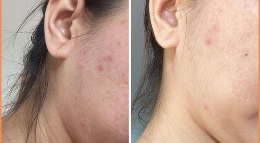 Top 5 Best Salicylic Acid Face Washes for Clear, Acne-Prone Skin AU BEAUTY BAZAAR - AU Beauty Bazaar